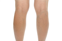 Leg Vein Treatment options